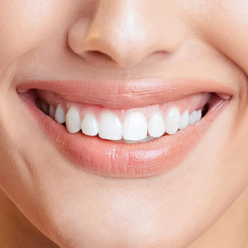 Estética Dental Clínica Dental Benadent